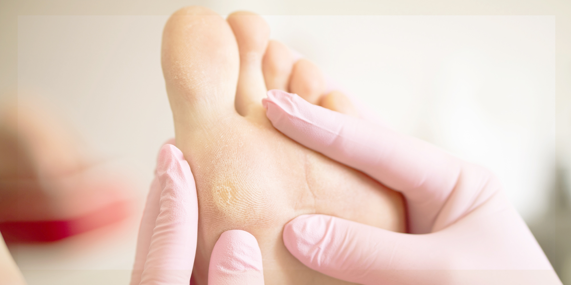 Entfernen von Hühneraugen