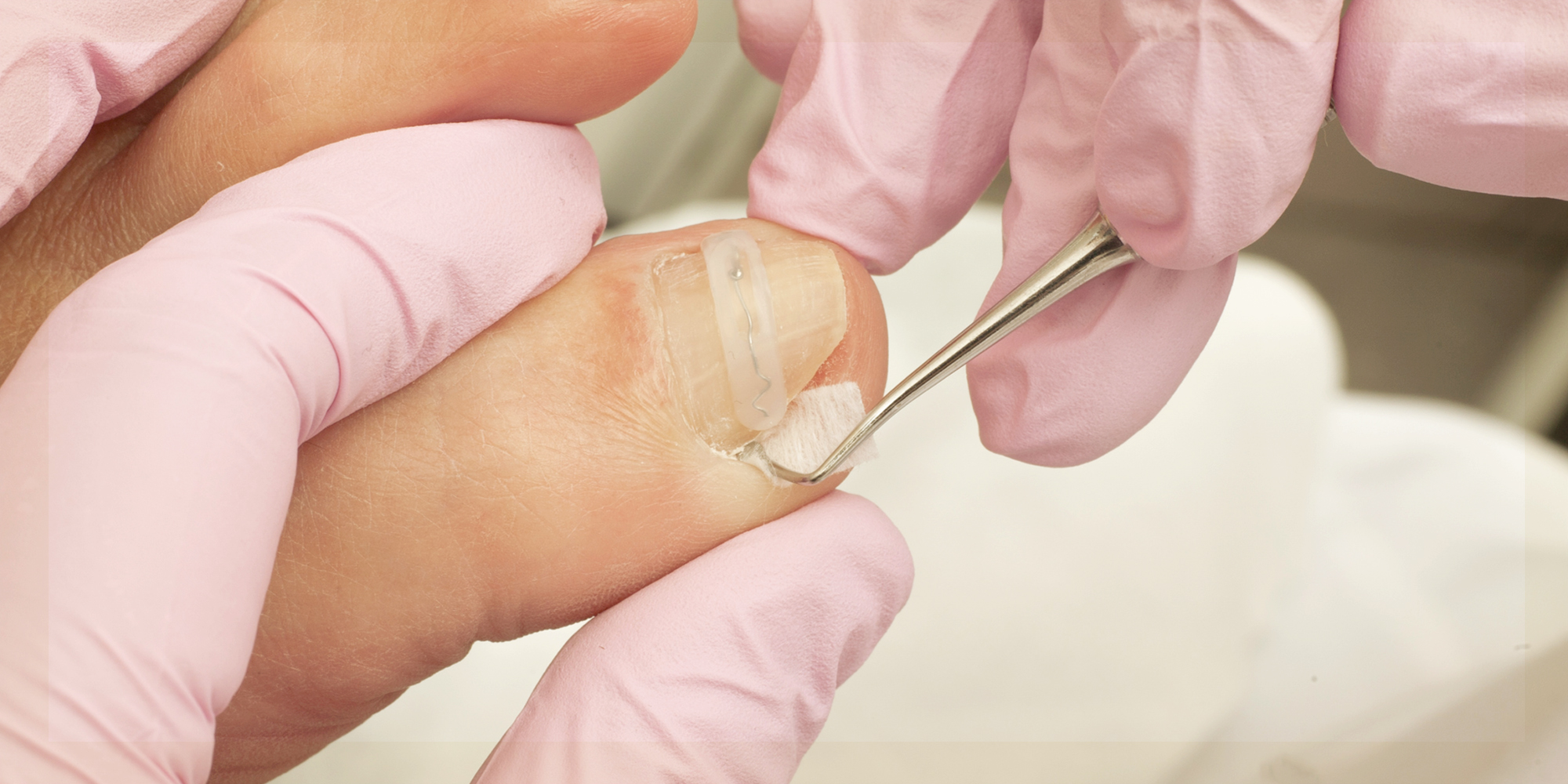 Entfernen von eingewachsenen Nägeln